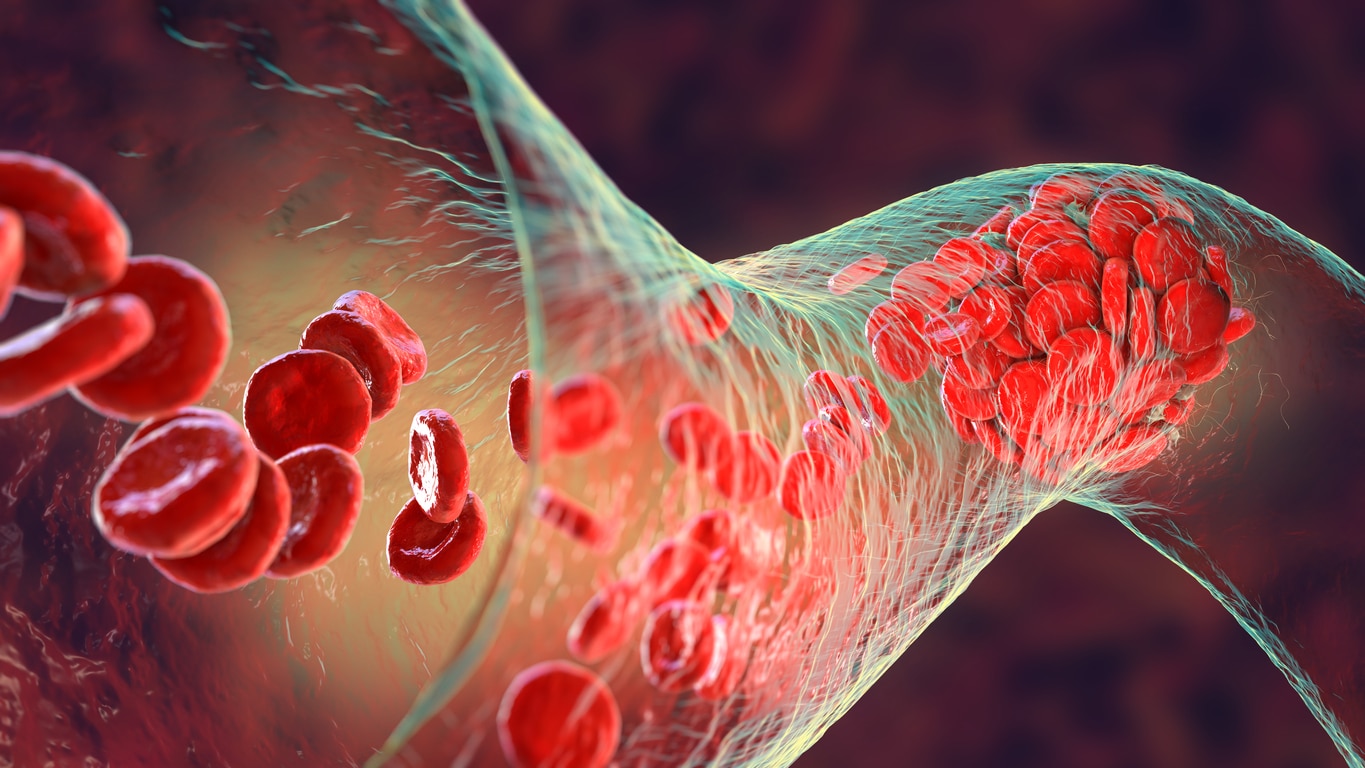 A trombózis jelei és laboratóriumi diagnosztizálási lehetősége a ProLabornál