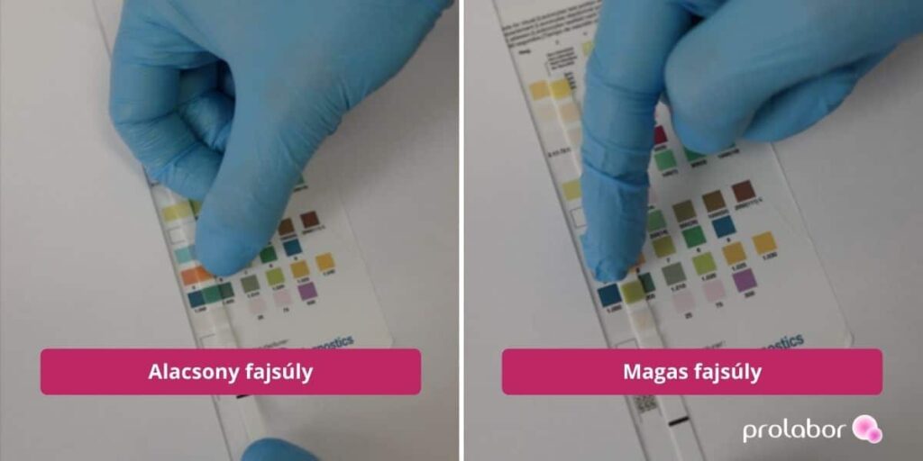 Vizeletvizsgálat eredménye: egy alacsony és magas fajsúly.