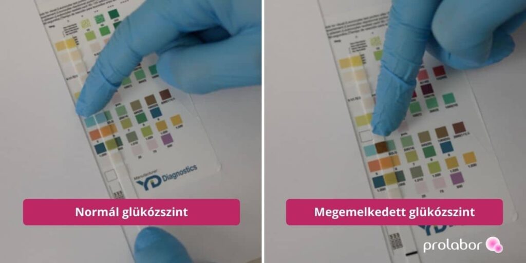 Vizeletvizsgálat eredménye: egy normál és egy magas glükózszint.