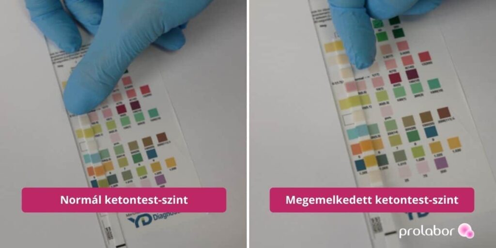 Vizeletvizsgálat eredménye: egy normál és egy emelkedett ketontest-szint.