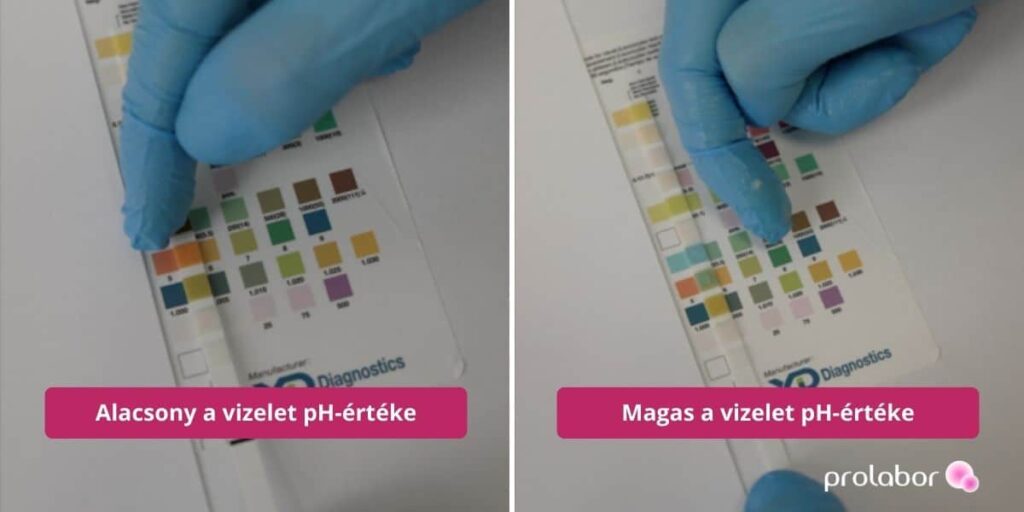 Vizeletvizsgálat eredménye: egy alacsony és egy magas vizelet pH-érték.